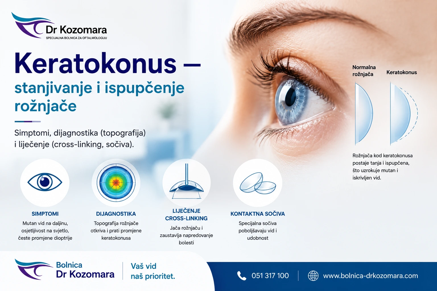 Keratokonus – stanjivanje i ispupčenje rožnjače, simptomi, dijagnostika i liječenje