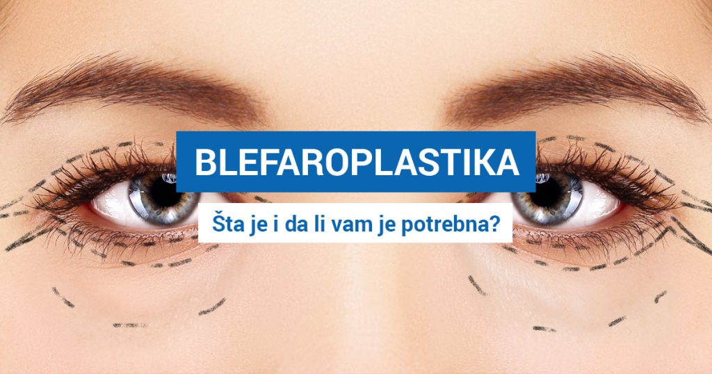 Blefaroplastika – Zatezanje donjih i/ili gornjih očnih kapaka (DA LI VAM JE POTREBNA?)