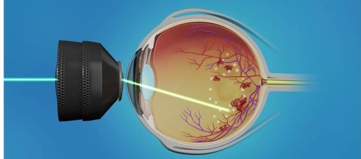 Uloga lasera u lijecenju dijabeticke retinopatije 1