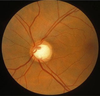 normotenzivni glaukom