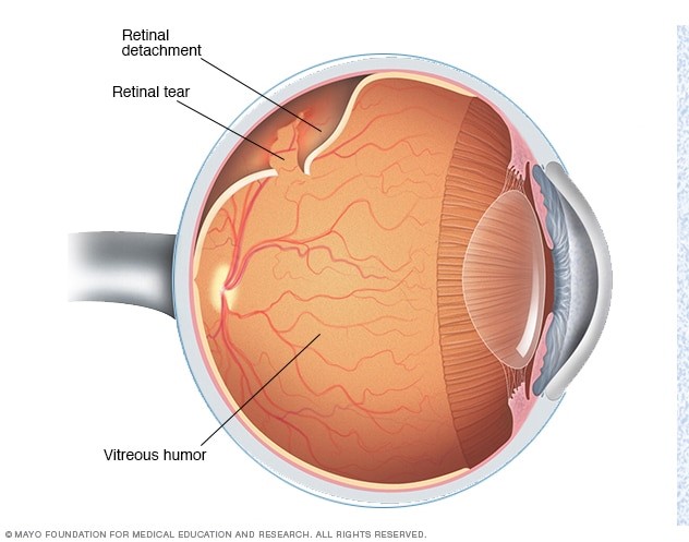 odvajanje retine