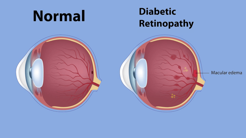 zdravo oko i dijabeticka retinopatija