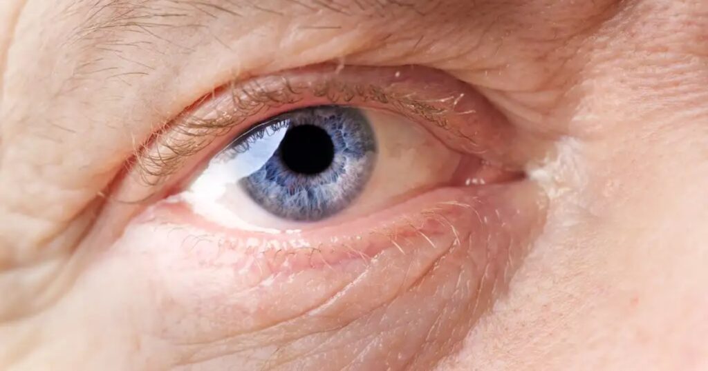 Glaukom – tihi kradljivac vida