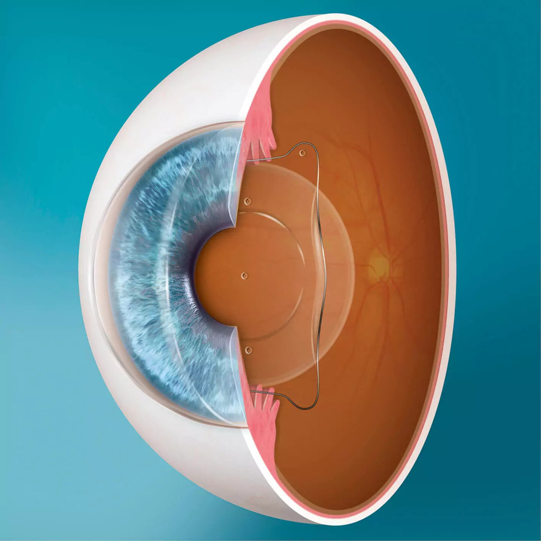 intraokularna sočiva, oftalmolog