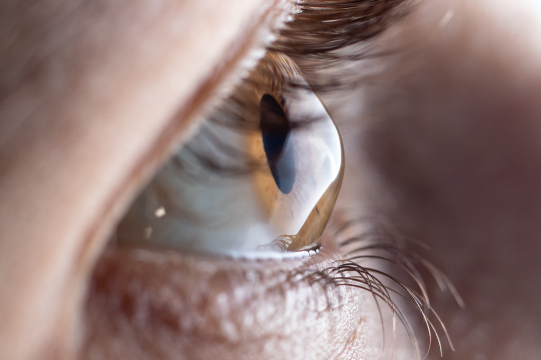 gray cataract, Dr. Kozomara, ophthalmologist